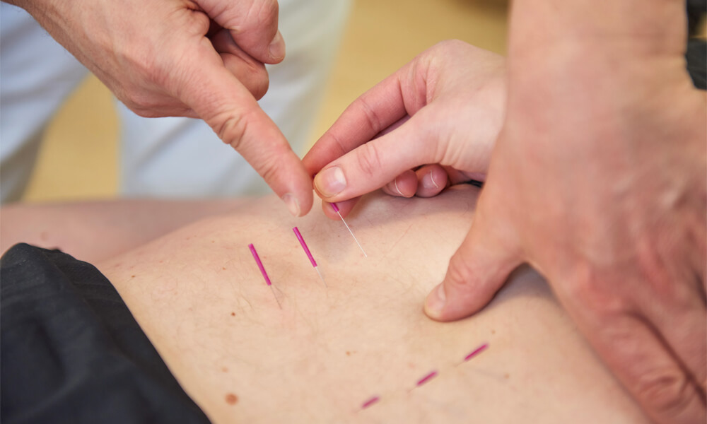 Akupunktur zur Schmerzbehandlung